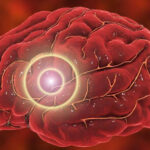 Avoiding Opioids, Many Patients in Pain Get Gabapentin Instead. Does It Work?