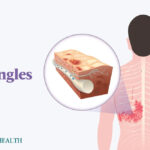 CDC Issues Alert for Potentially Deadly Outbreak Linked to Recalled Products